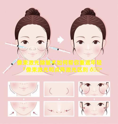 像束激光除皱术如何帮你重返年轻「像束激光和点阵激光区别 💮 」